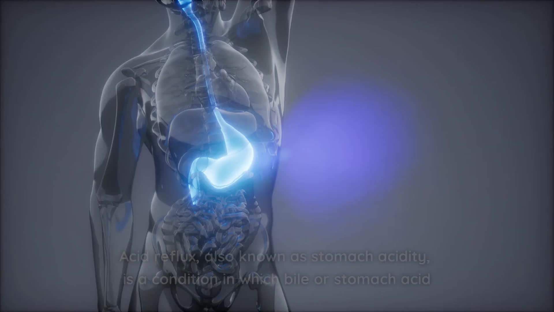 Illustration of stomach acid flowing back into the esophagus