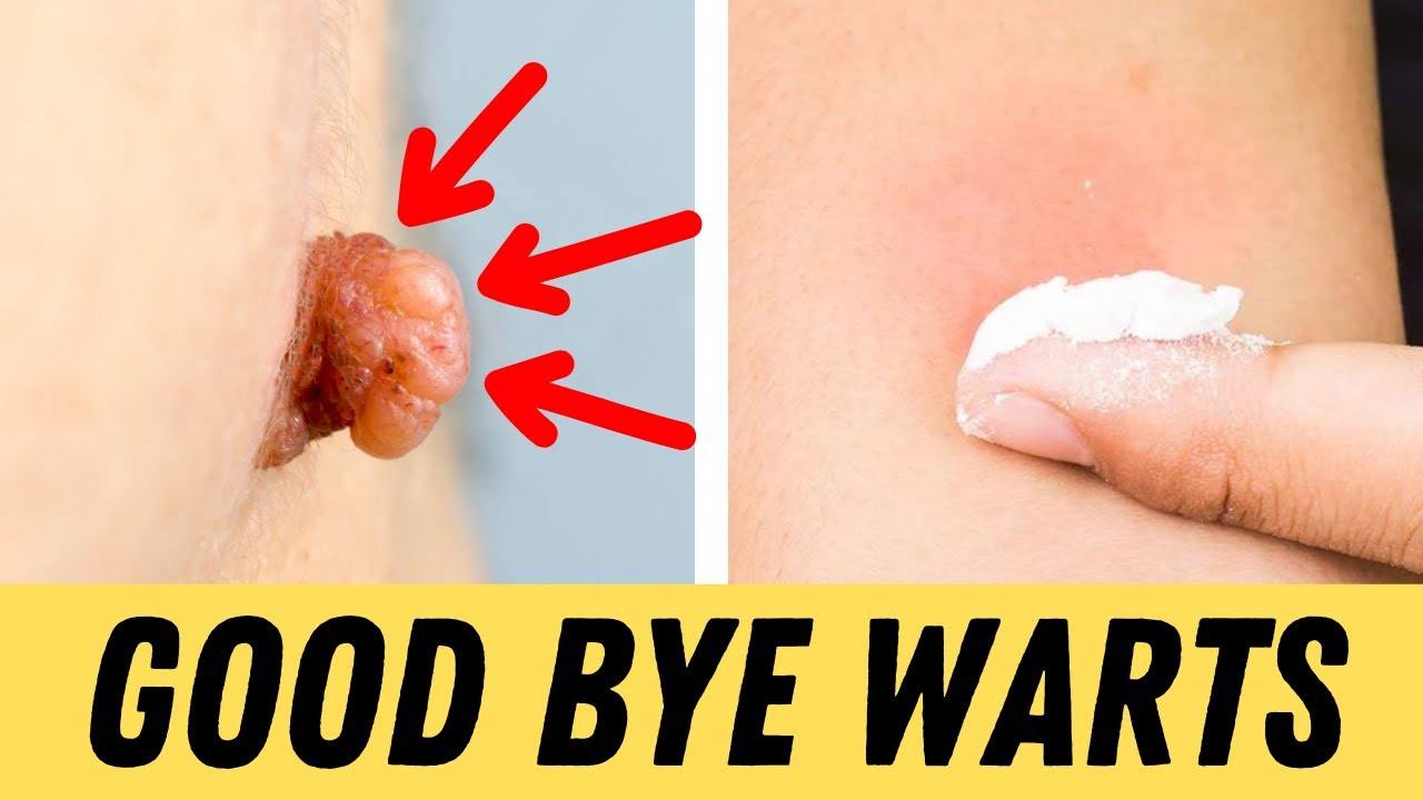 Say Goodbye to Warts with This Simple Home Remedy