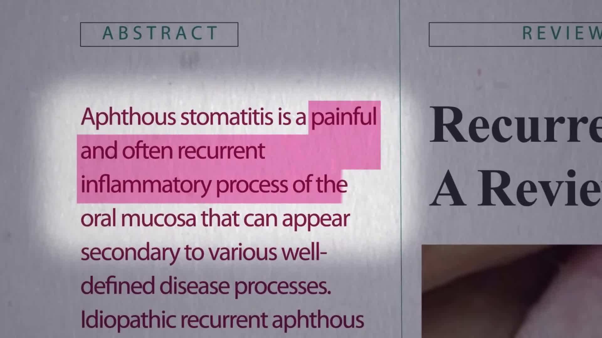 Antioxidants play a crucial role in canker sore treatment